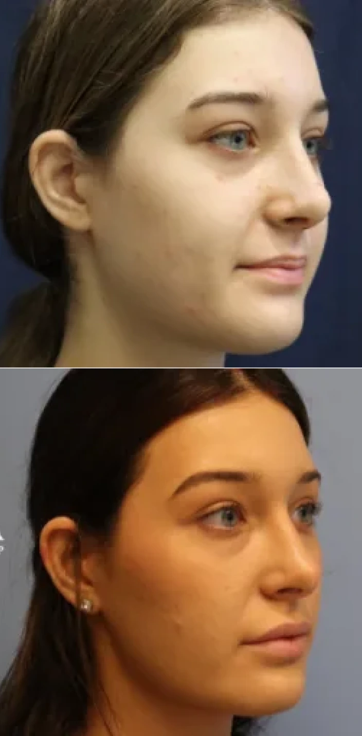 Rhinoplasty before and after comparison showing patient profile view