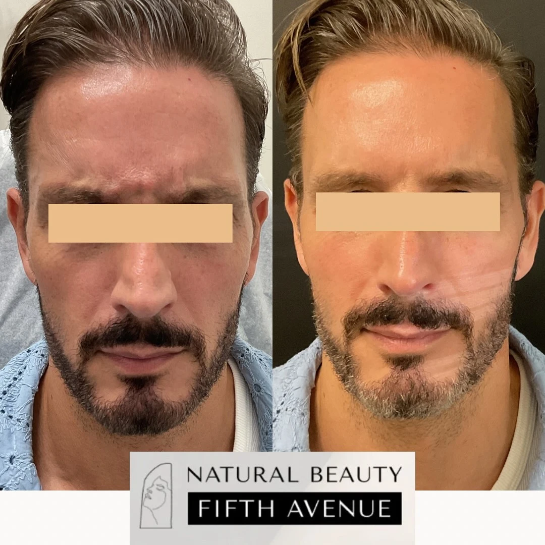 Before and after Botox treatment showing reduced forehead wrinkles and smoother skin texture