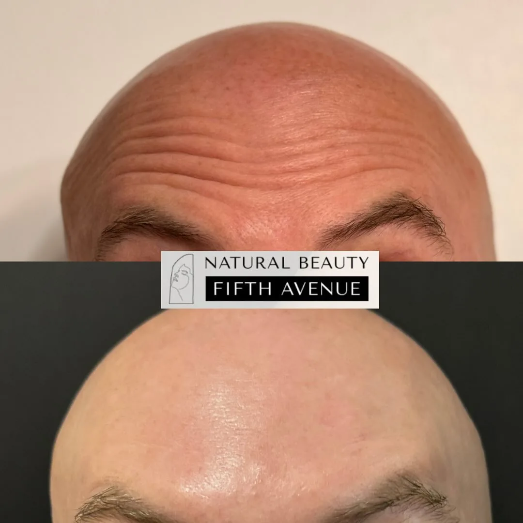 Before and after Botox treatment showing forehead wrinkle reduction