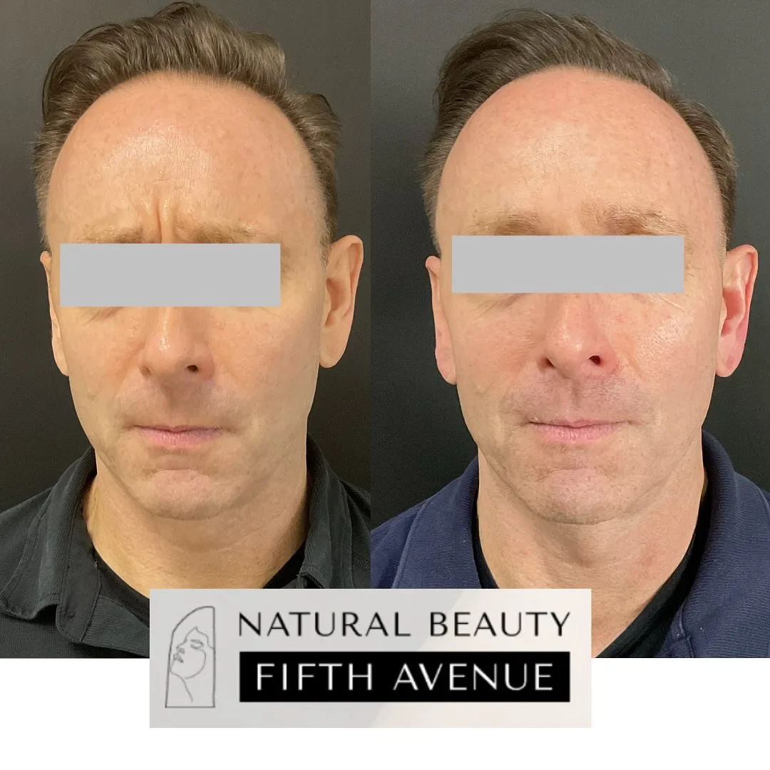 Before and after Botox treatment showing reduced forehead wrinkles