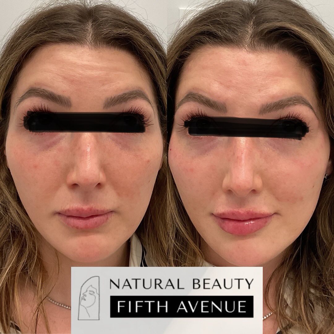 Before and after facial comparison showing reduced forehead lines with DAXXIFY® treatment