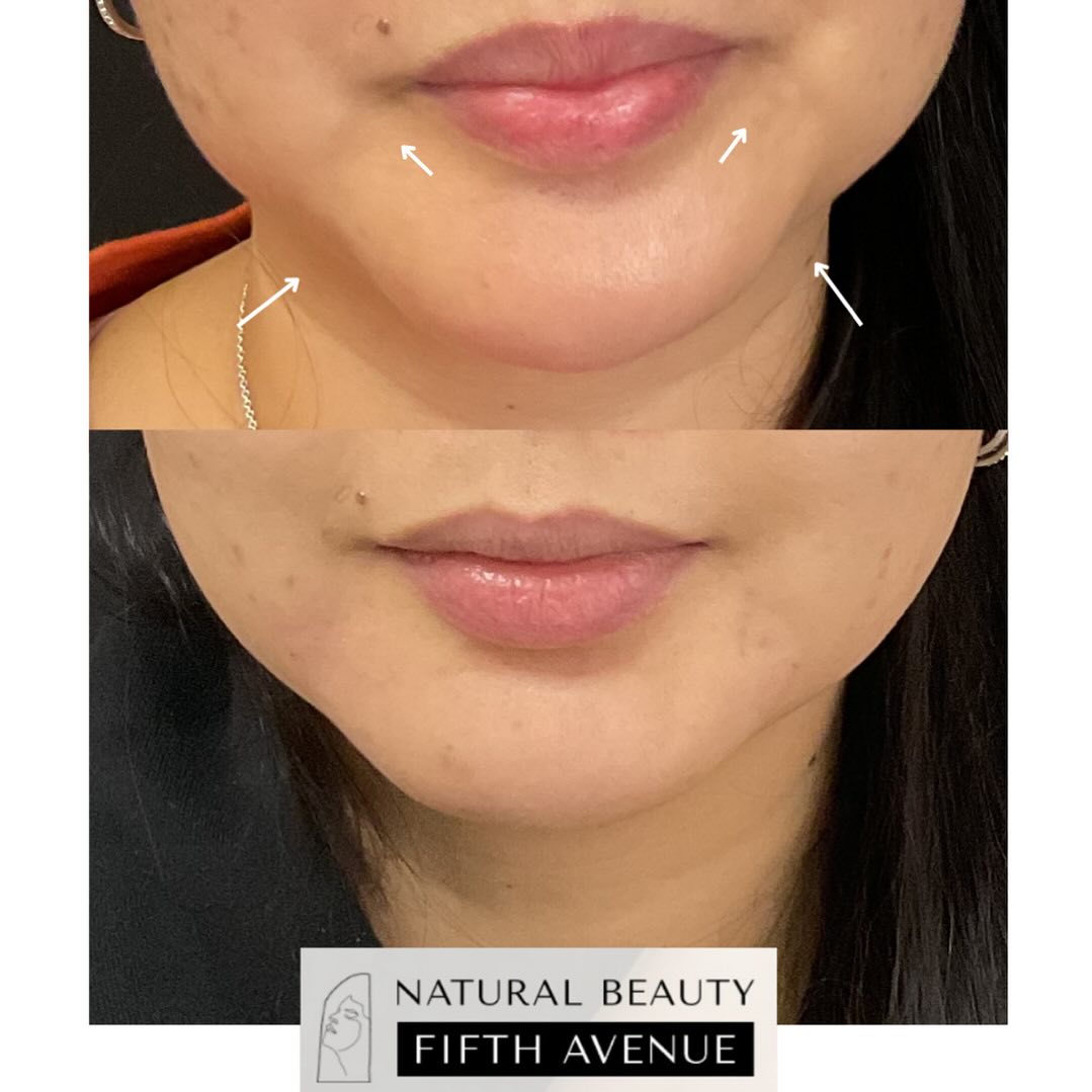 Before and after Juvederm treatment showing fuller lips and smoothed marionette lines