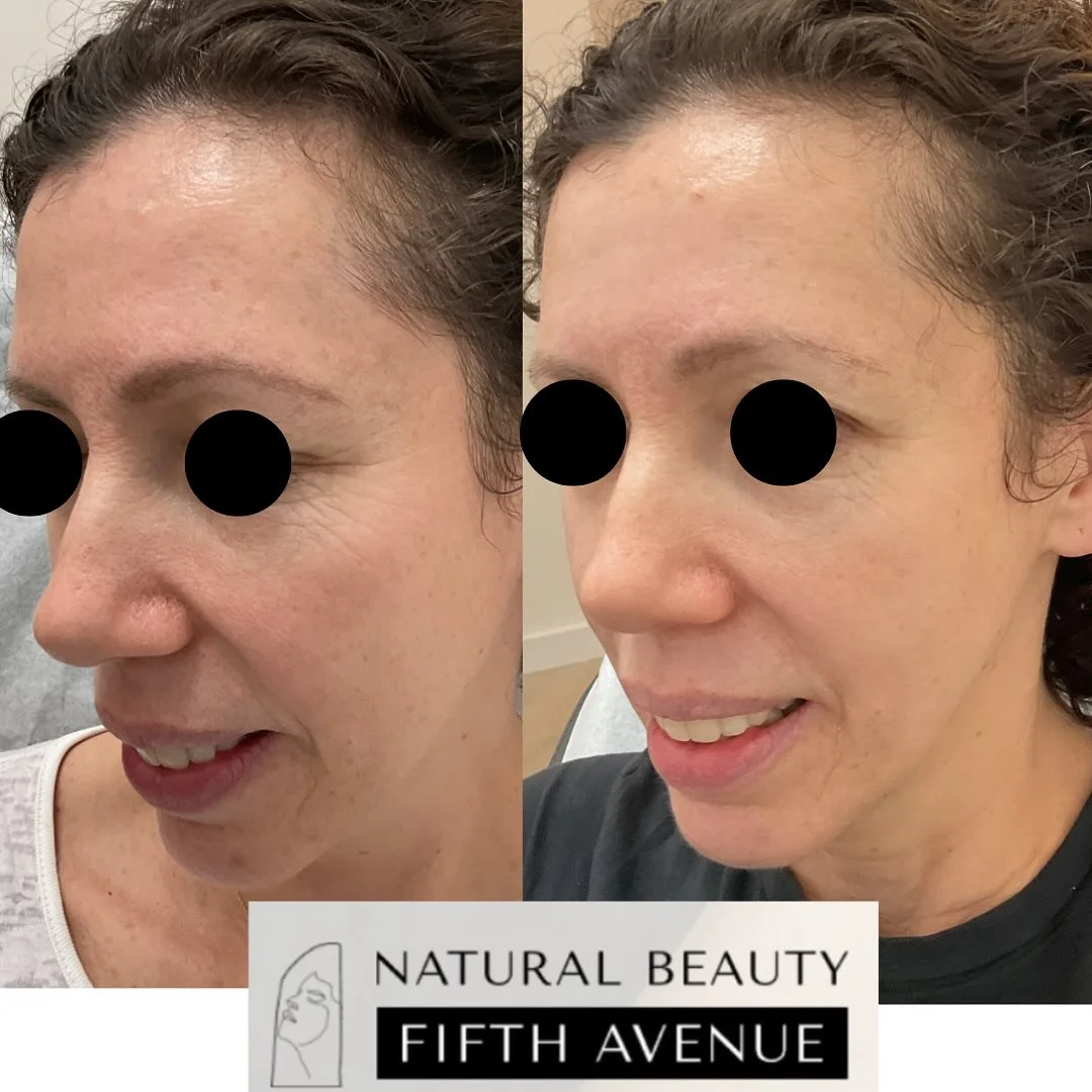 Before and after microneedling results showing reduced forehead wrinkles and improved skin texture
