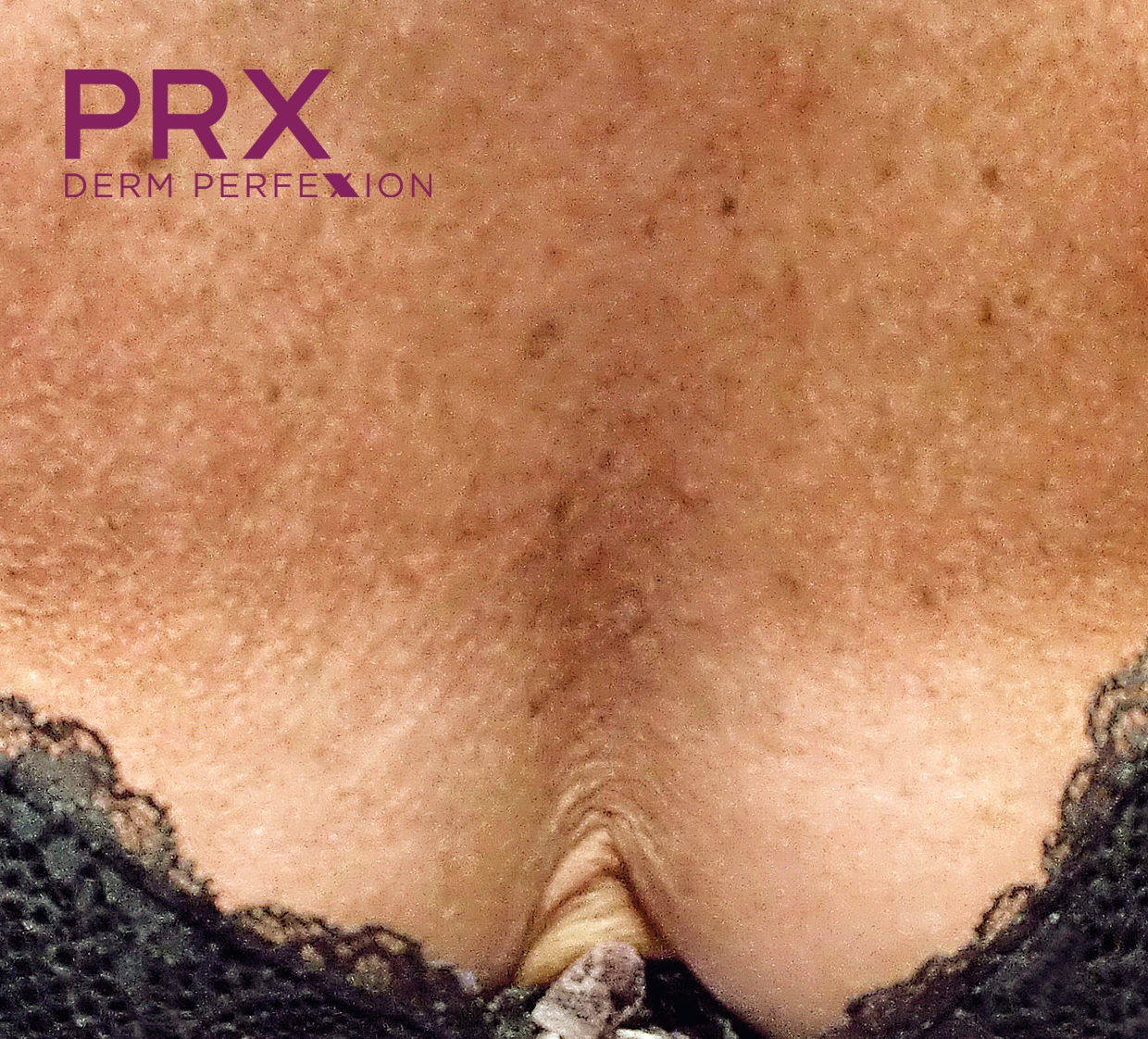 PRX DERM PERFEXION after result showing improved skin texture and tone on decollete area