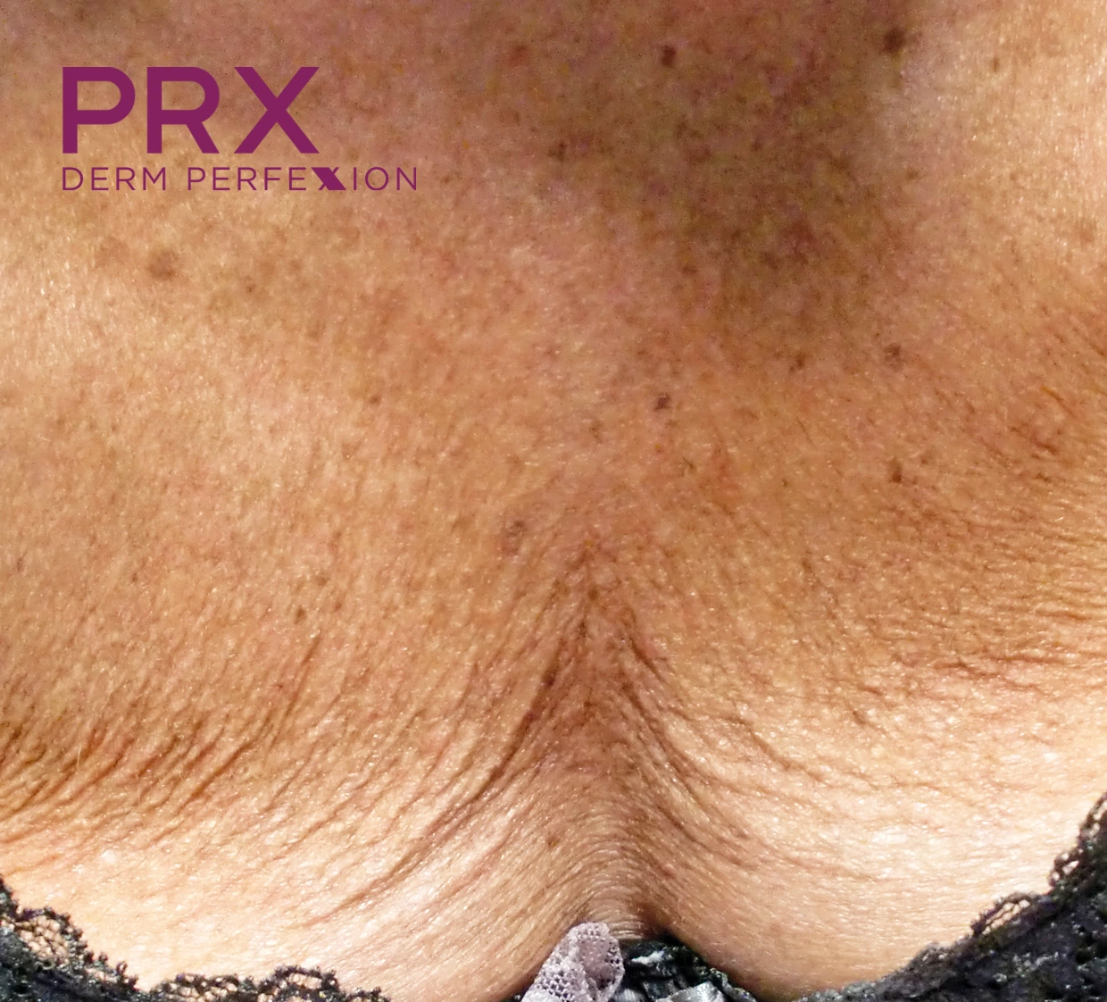 Decollete skin with sun damage and fine lines before PRX DERM PERFEXION treatment