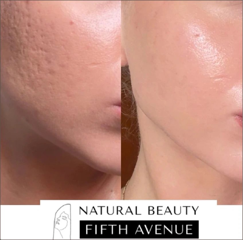 Before and after comparison of skin texture and clarity on cheek and jawline after PRX treatment