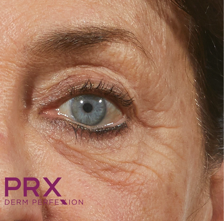 Close-up of a patient's eye and surrounding skin showing fine lines and texture, with PRX Derm Perfexion text overlay
