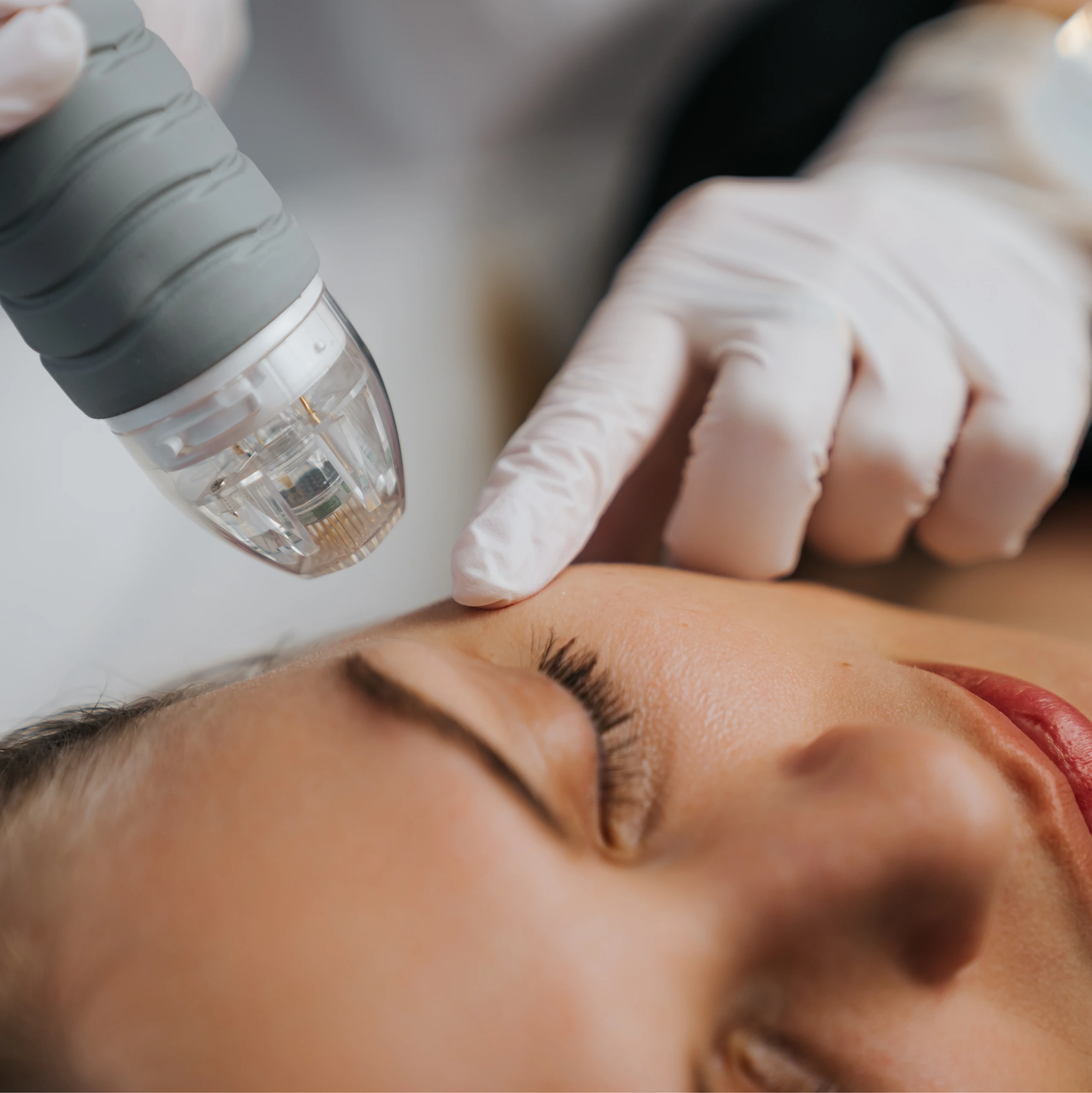 Practitioner using RF microneedling device on patient's cheek during treatment