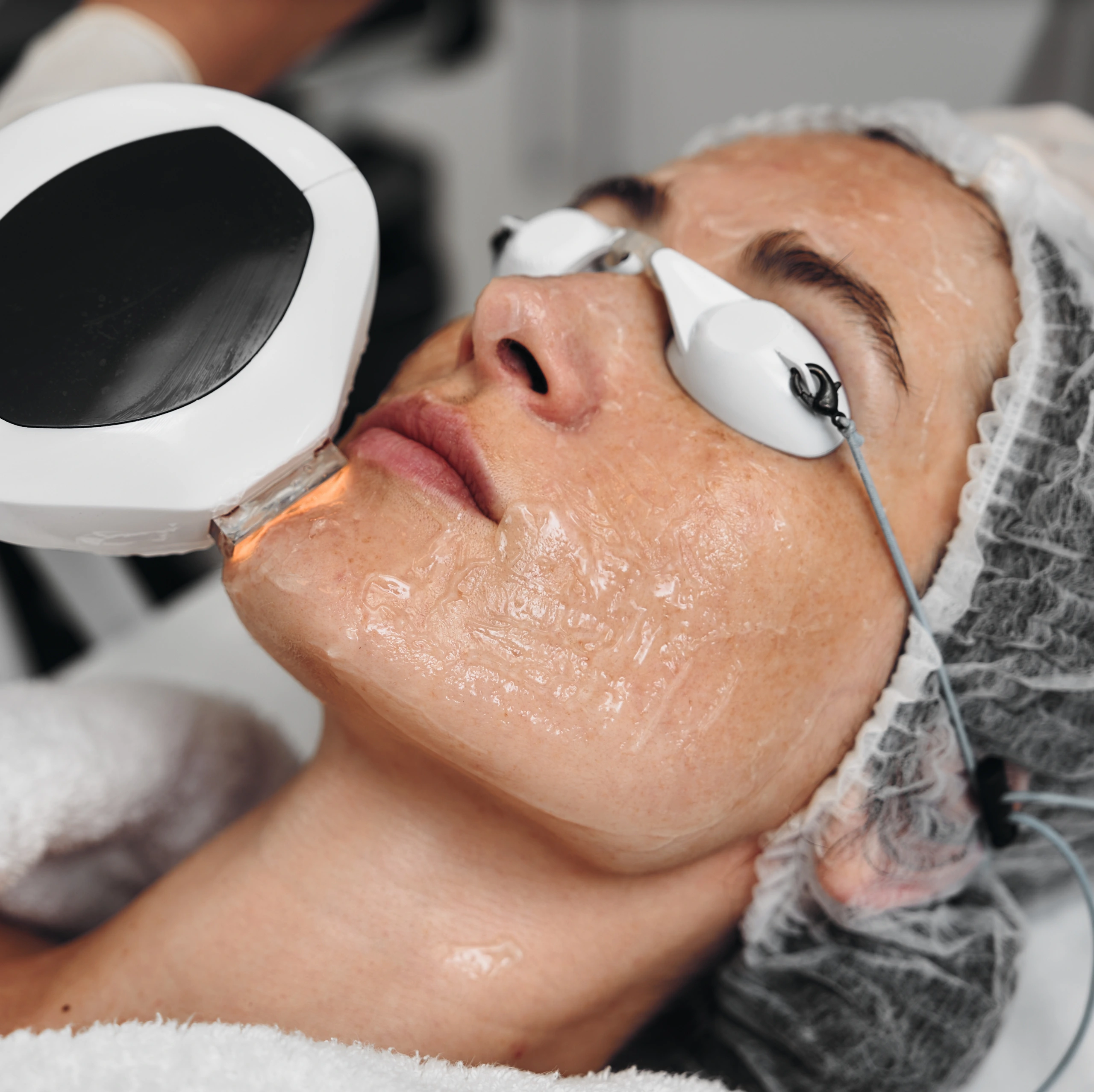 Patient receiving IPL treatment to the face with protective eyewear and handheld device