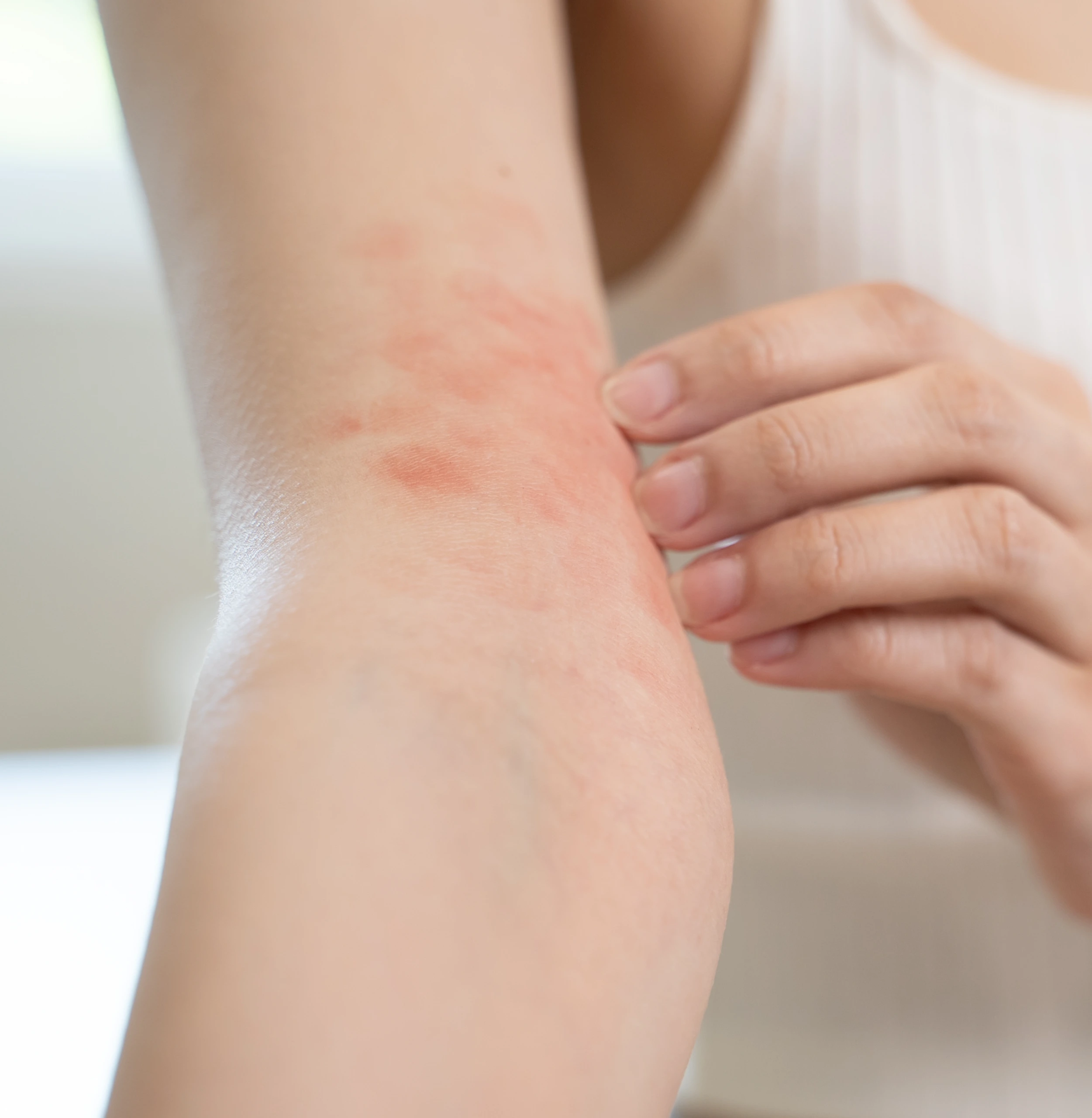 Close-up of a person's arm showing red, irritated skin patches consistent with eczema