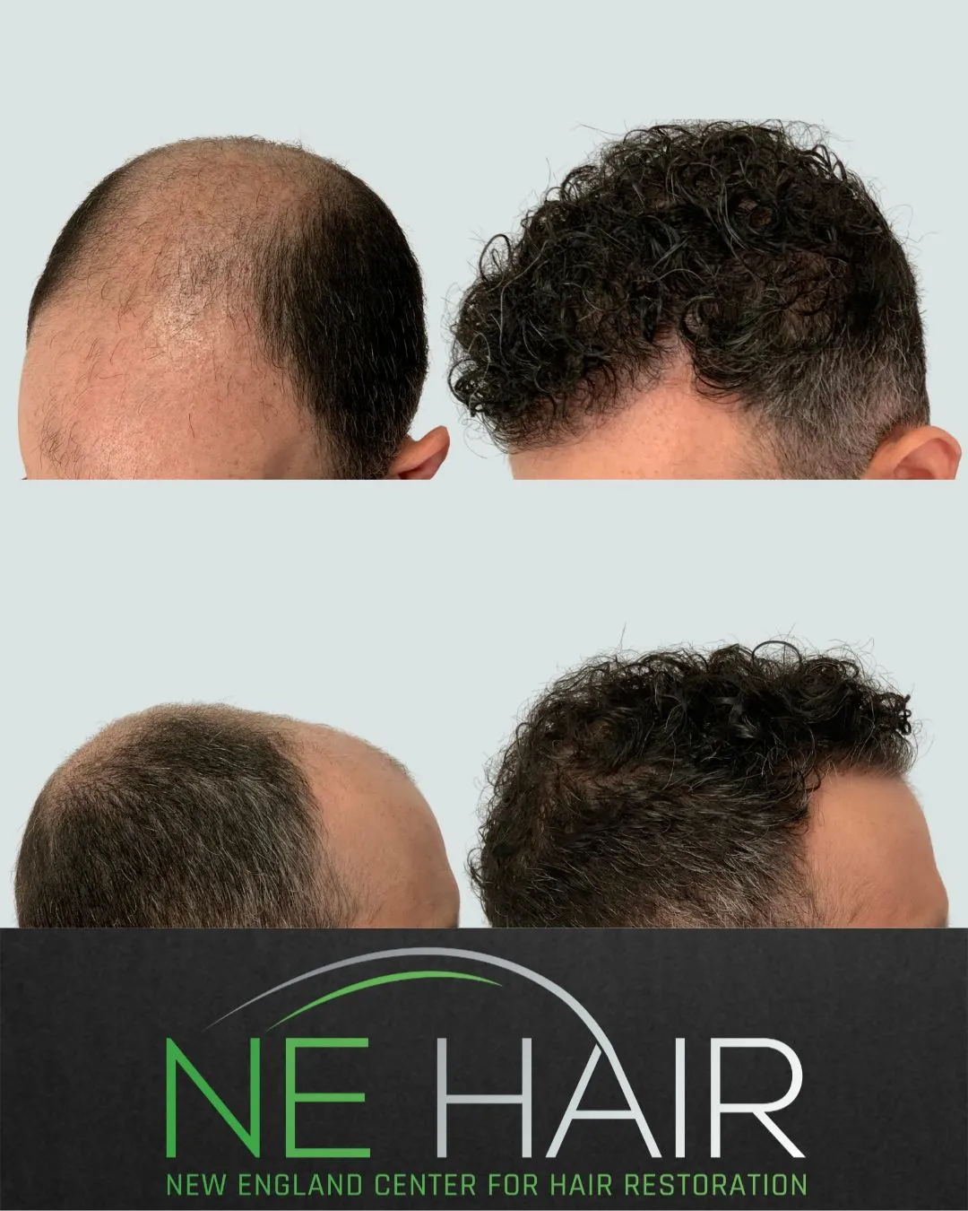 11_25 - Ryan Guidice - 7500 Grafts - 1 year post op