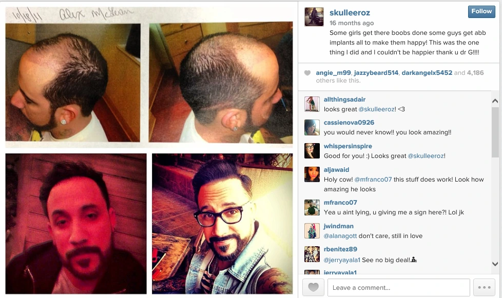 Hair Transplant Surgery in Boston, MA