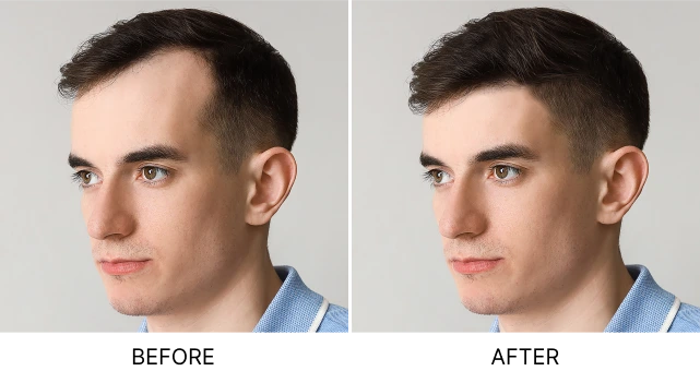 What Is Follicular Unit Transplantation? Banner