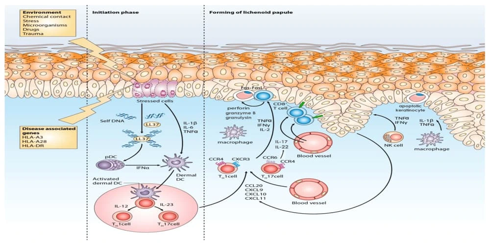 Understanding Lichen Planopilaris (LPP)
