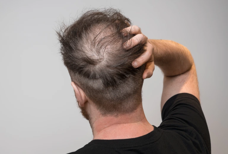 Candidates for Follicular Unit Transplant Banner