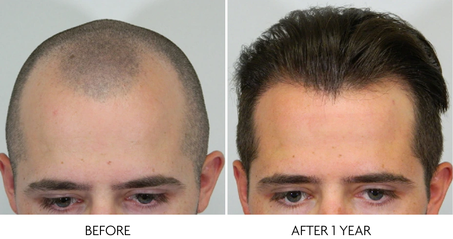 micro FUE™ Before & After
