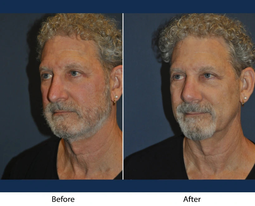 Only Faces Template (78)