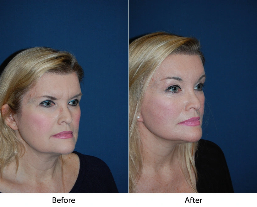 Aggressive 3-4 Brow Lift Before & After Banner