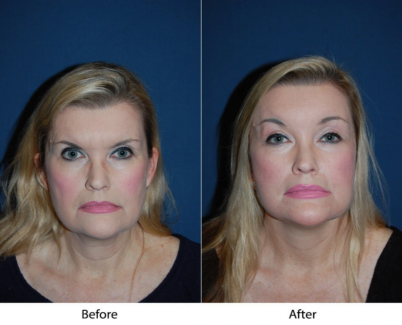 Aggressive 3\4 Brow lift Banner