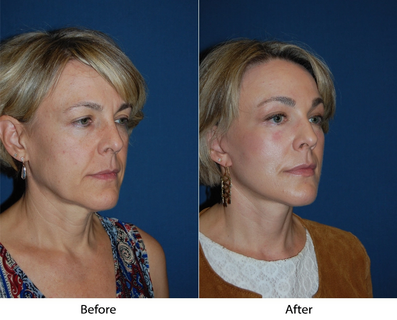 Aggressive Lateral Brow Lift Before & After Banner