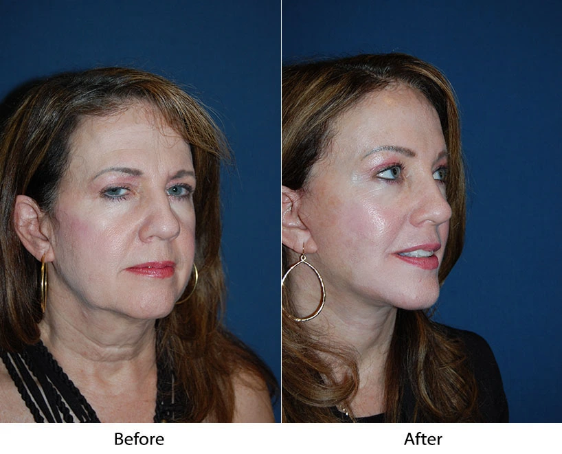 Asymmetrical Brow Lift Before & After Banner