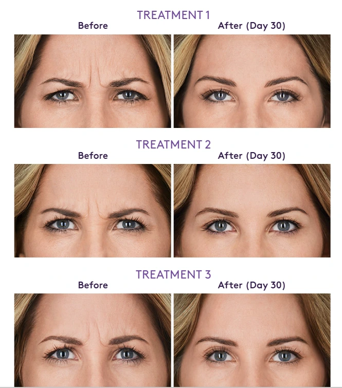 Neuromodulators Before & After Banner