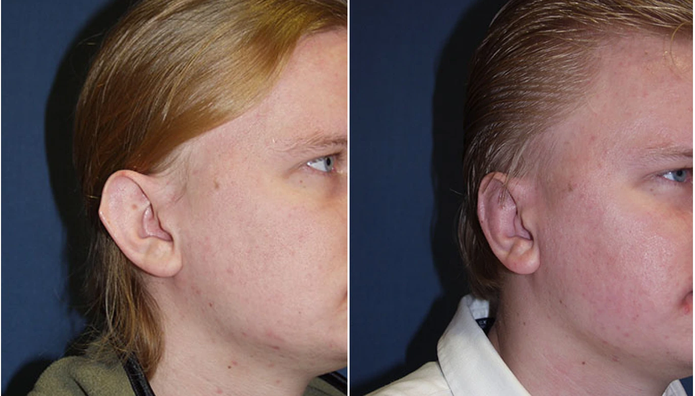 Before & After Otoplasty Banner
