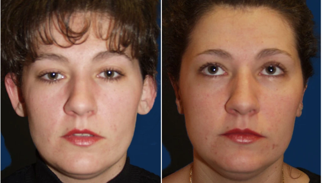 Before & After Picture Otoplasty Banner