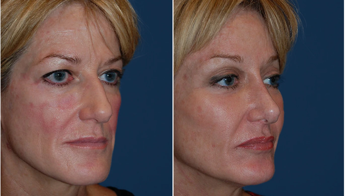 Cheek Implant Before & After Banner