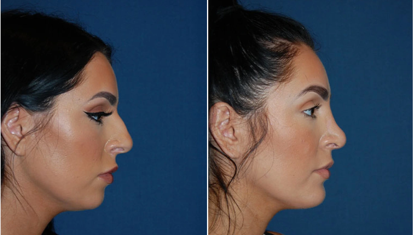 Chin Implant Before & After