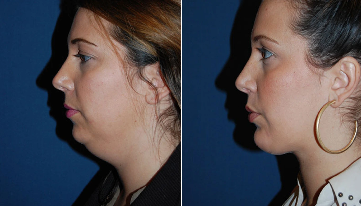 Neck Lift Before & After