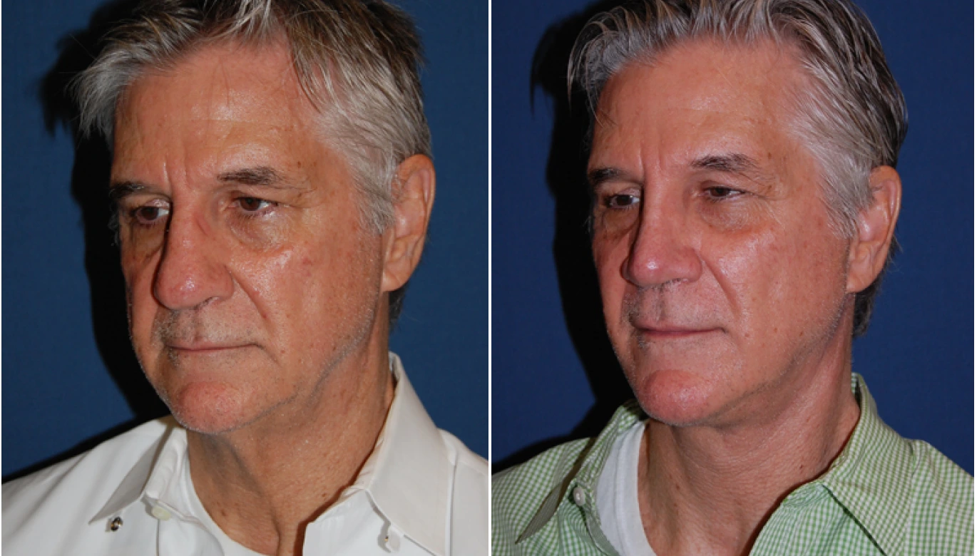 Neck Lift Before & After