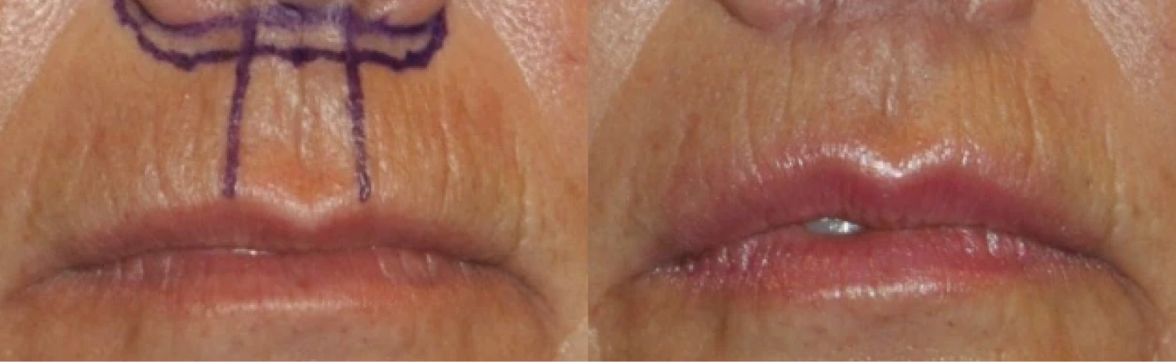 Lip Lift Before & After Banner