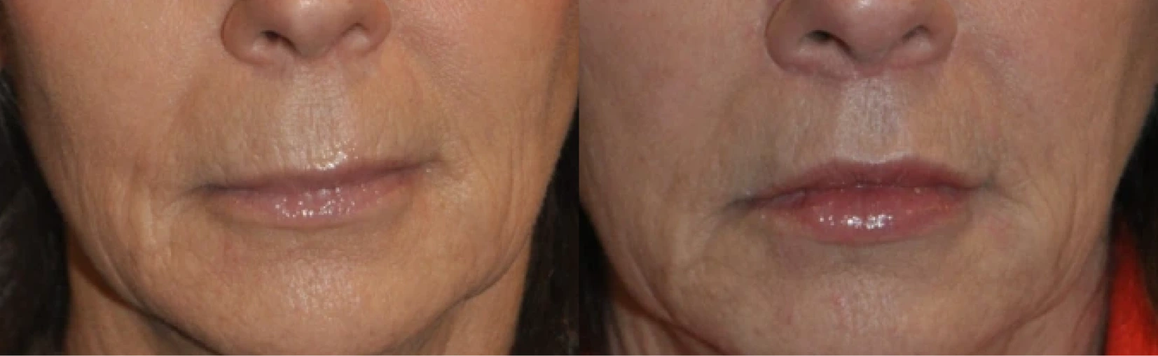 Lip Lift Before & After Banner