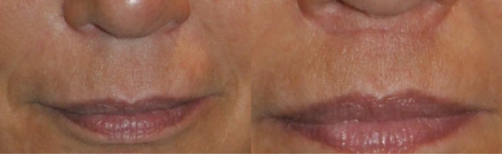Lip Lift Before & After Banner