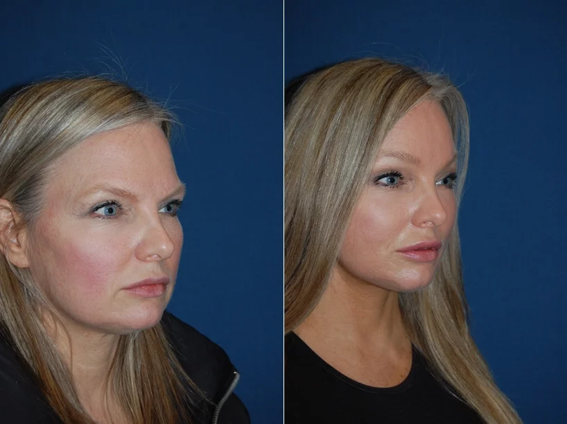 Facelift Before & After Results Banner