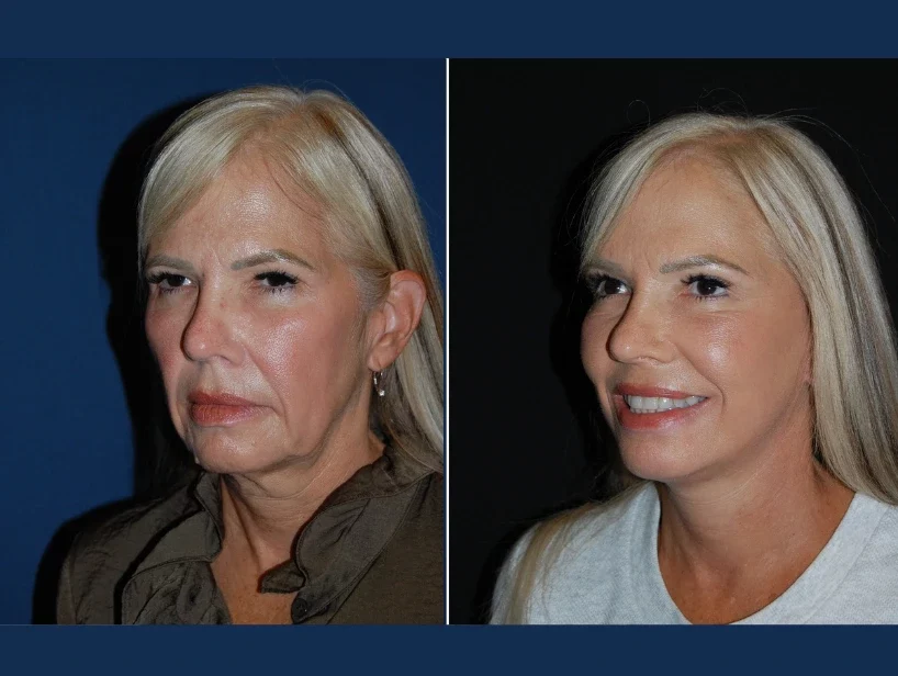 Facelift Before & After Results Banner