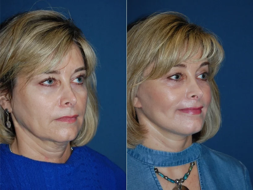 Facelift Before & After Results Banner