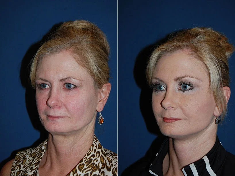 Facelift Before & After Results Banner