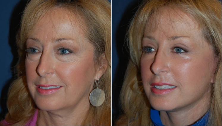 Facelift Before And After Results Banner