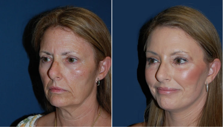 Facelift Before And After Results Banner