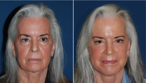 Facelift Before And After Results Banner
