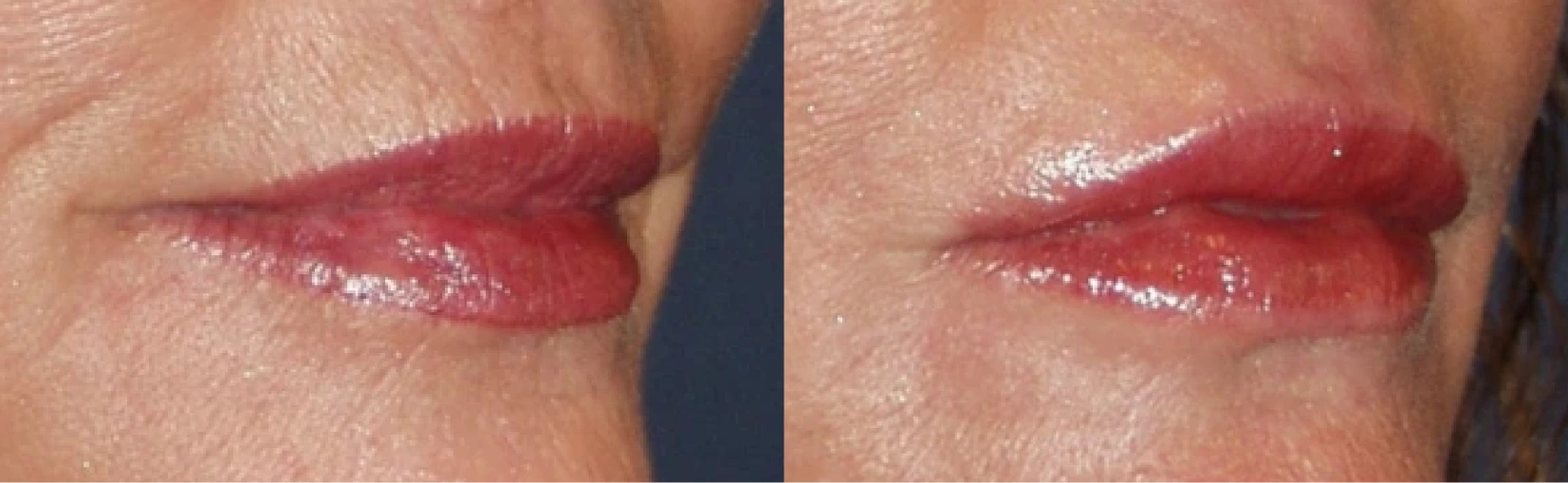 Lip Implant Before and After Banner
