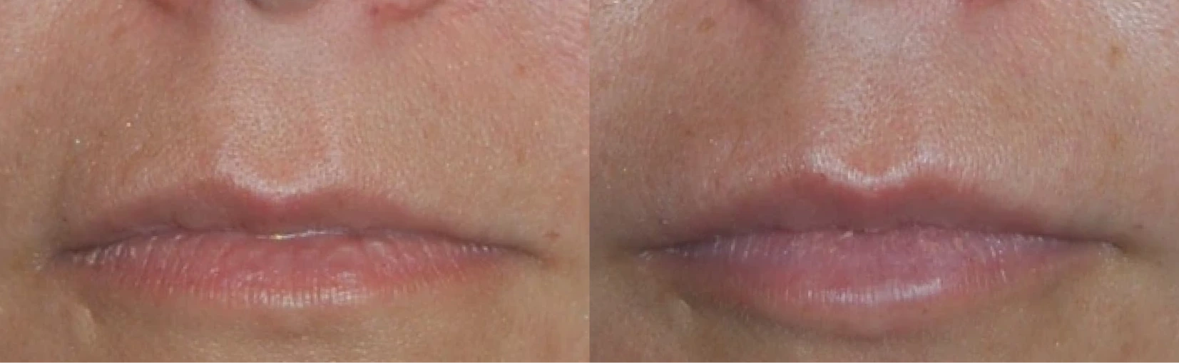 Lip Implant Before and After Banner