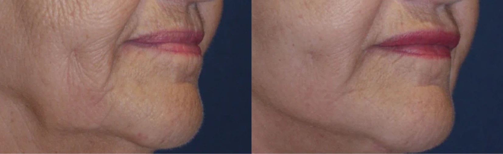Lip Implant Before and After Banner