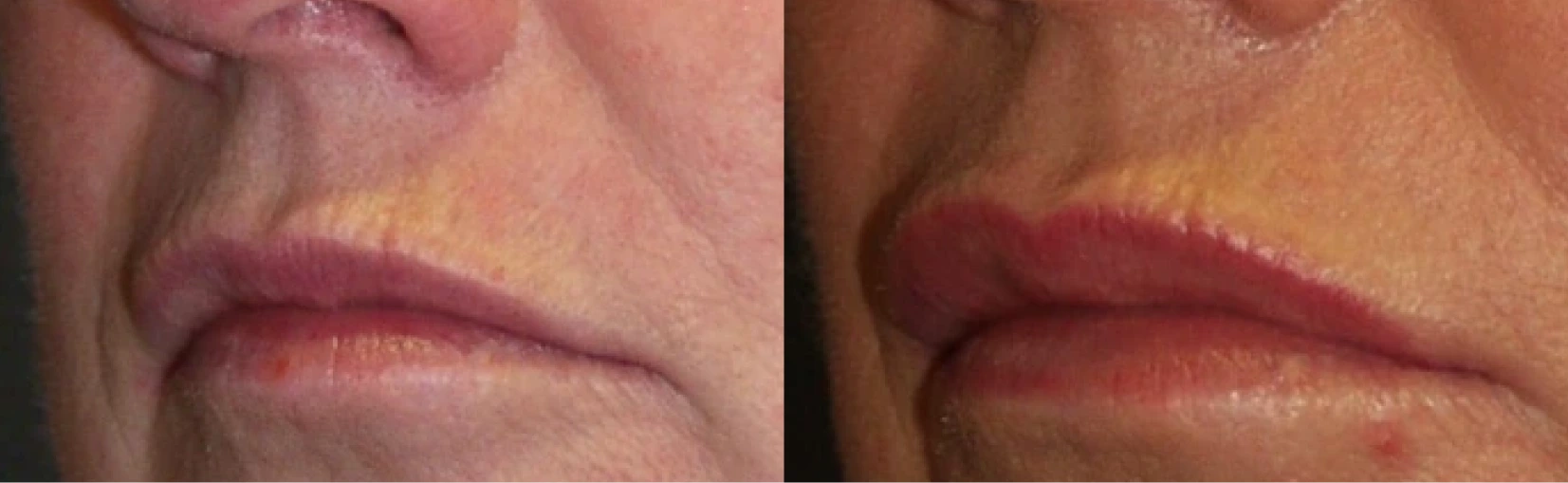 Lip Implant Before and After Banner