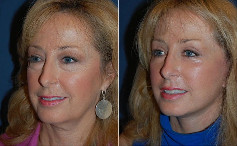 Before & After Gallery: Upper Blepharoplasty
