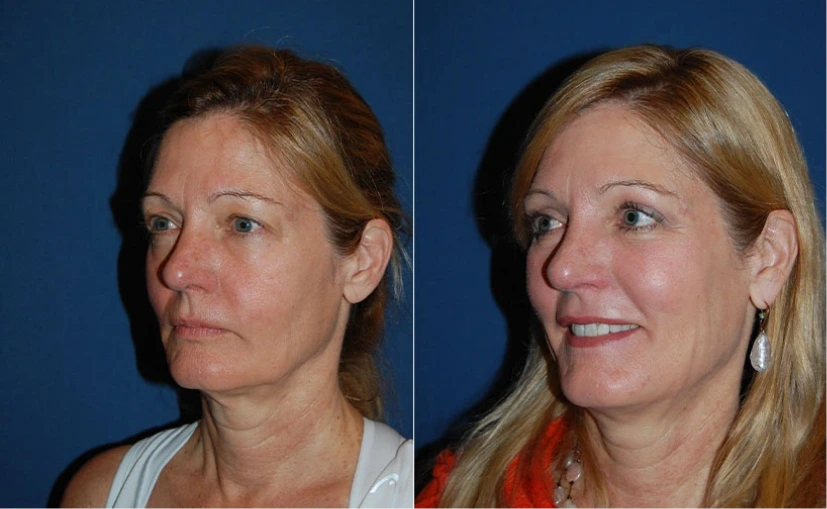 Before & After Gallery: Upper Blepharoplasty