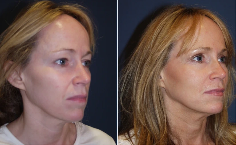 Before & After Gallery: Upper Blepharoplasty
