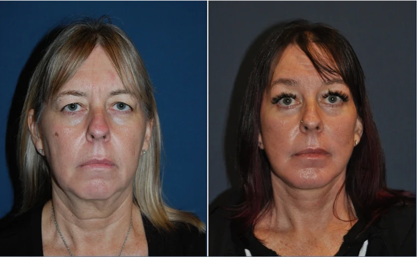 Before & After Pictures: Facial Implants